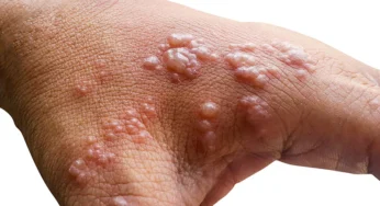 Herpes Zoster: Caused by Reactivation of the Chickenpox Virus